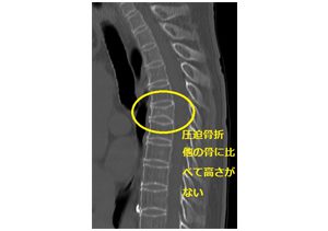 圧迫骨折｜CT画像